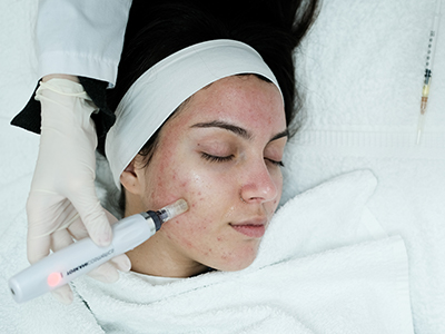 Why Women Hair Transplant